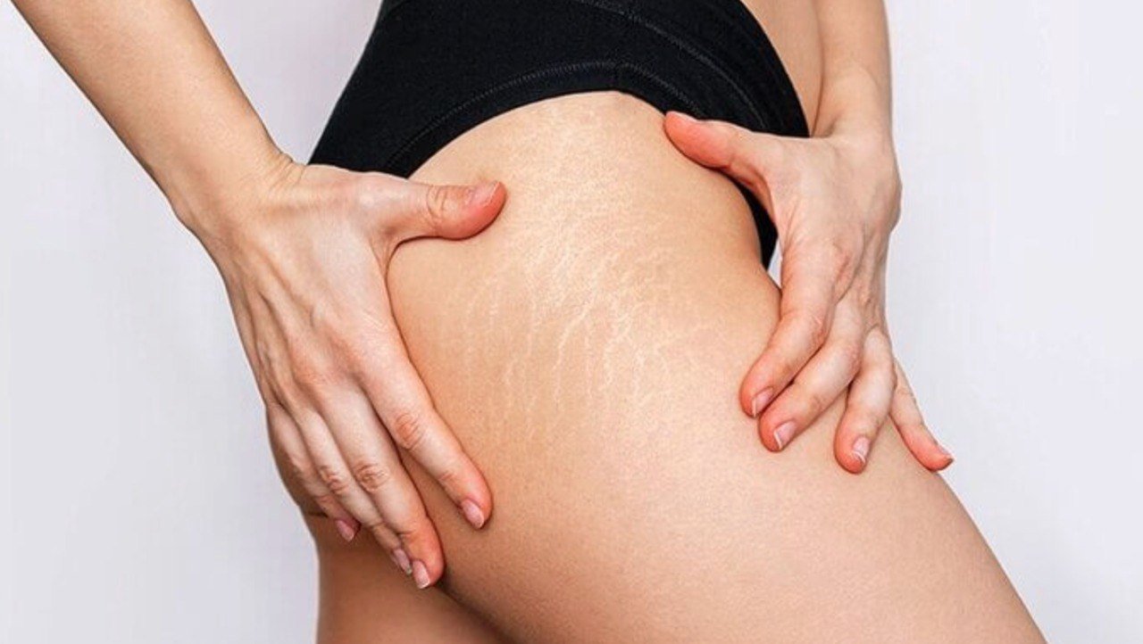 Як боротися зі стріями на шкірі